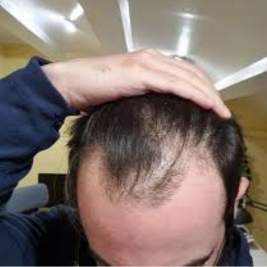 Finasteride After Hair Transplant