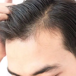 Dry Scalp Dandruff Natural Treatment