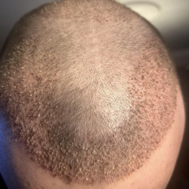 Smoking After Hair Transplant
